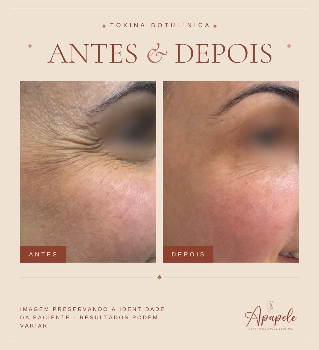 Comparativo antes e depois de toxina botulínica nas linhas de expressão ao redor dos olhos realizada na Apapele, com a identidade da paciente preservada